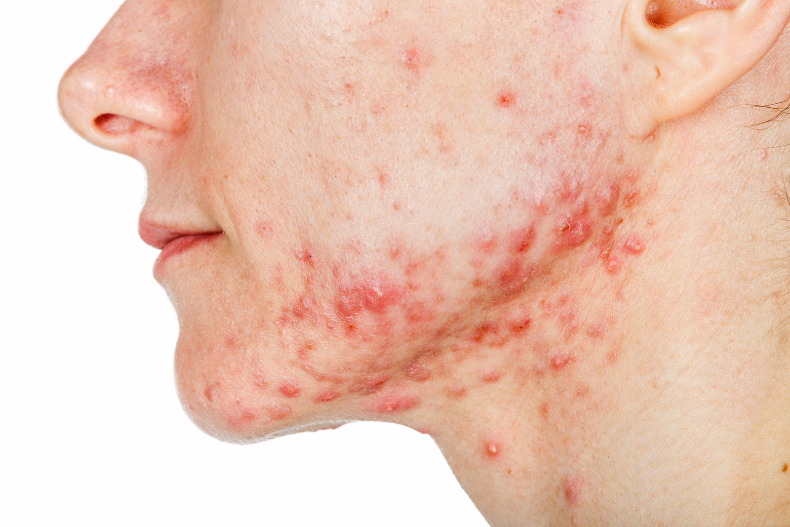 Acne and Pimples