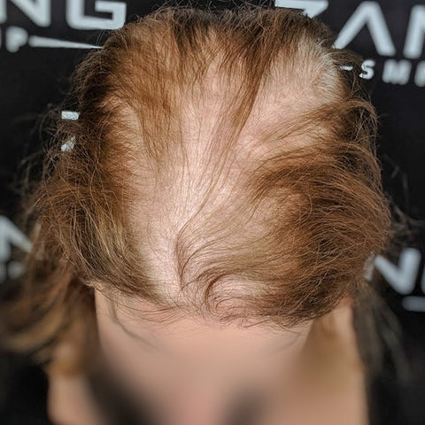 Alopecia Areata