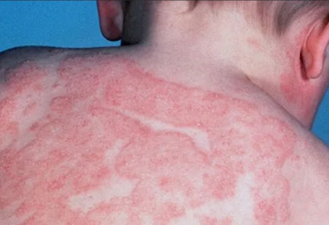 Atopic dermatitis