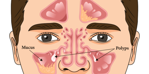 Chronic Sinusitis