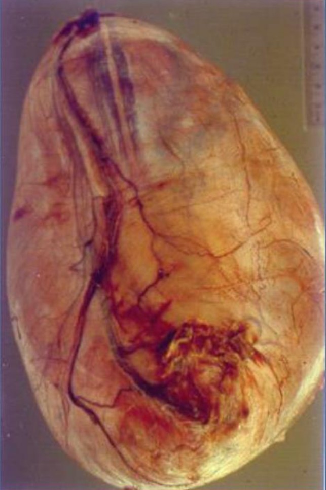 Hydrocele