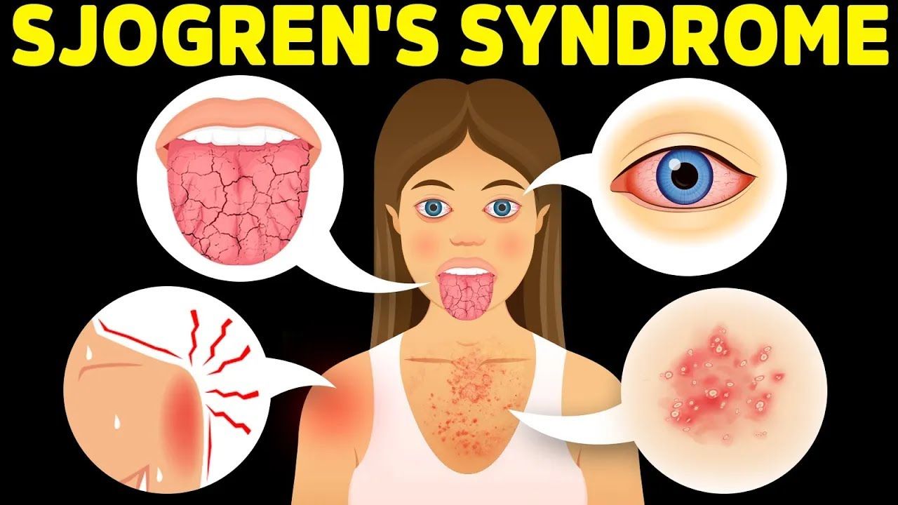 Sjögren's Syndrome