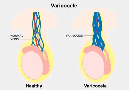 Varicocele