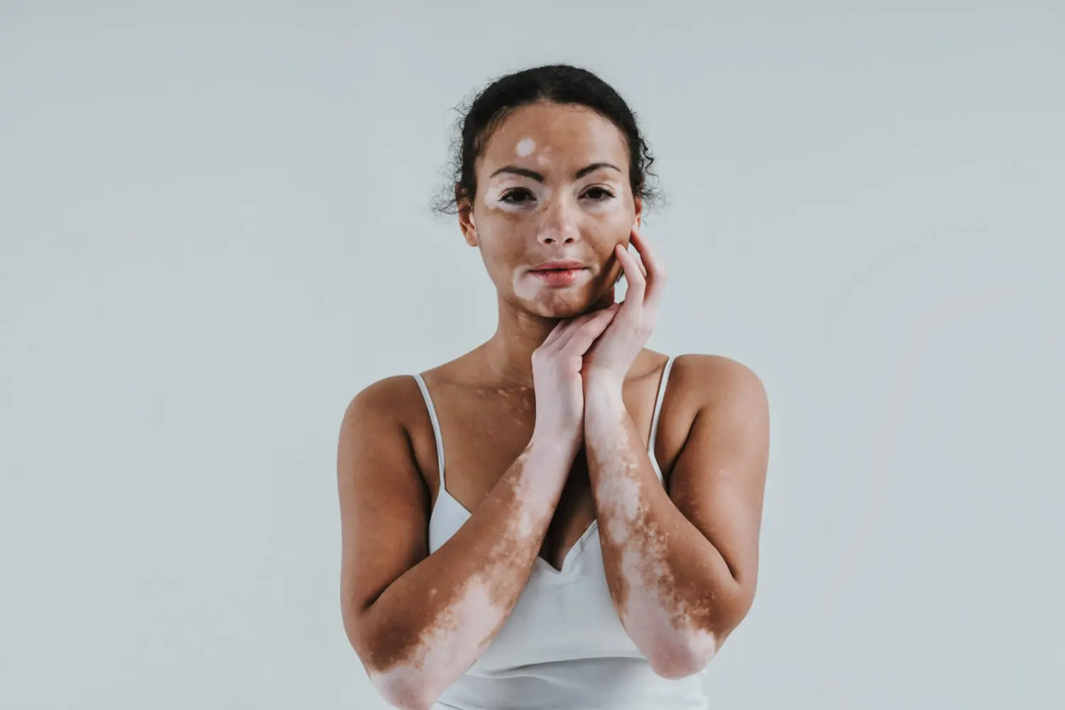 Vitiligo